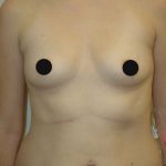 Breast Augmentation Before & After Patient #984