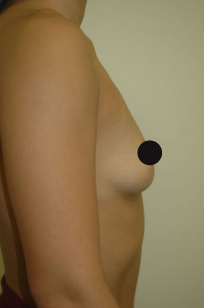 Breast Augmentation Before & After Patient #983