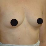 Breast Augmentation Before & After Patient #982