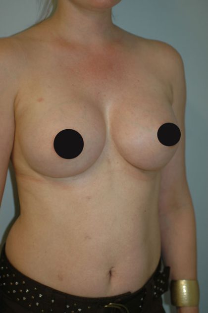 Breast Augmentation Before & After Patient #982