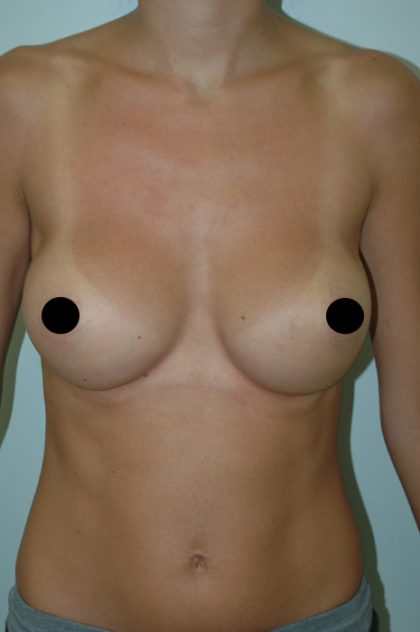 Breast Augmentation Before & After Patient #981