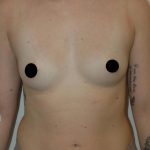 Breast Augmentation Before & After Patient #980