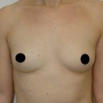 Breast Augmentation Before & After Patient #979