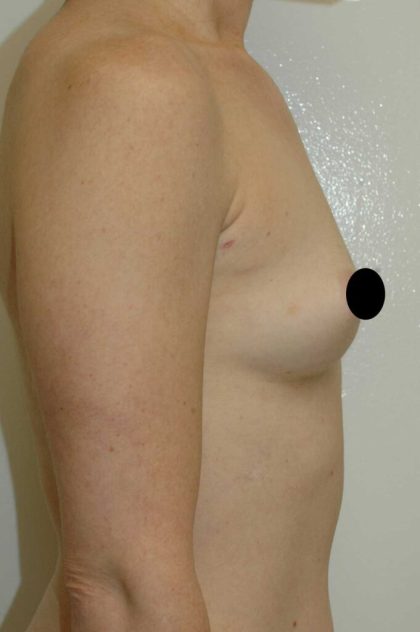 Breast Augmentation Before & After Patient #979
