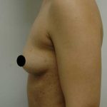 Breast Augmentation Before & After Patient #1002