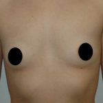 Breast Augmentation Before & After Patient #1001