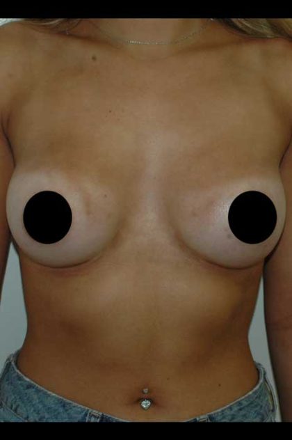 Breast Augmentation Before & After Patient #1001