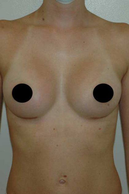 Breast Augmentation Before & After Patient #1000