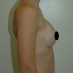 Breast Augmentation Before & After Patient #1000