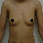 Breast Augmentation Before & After Patient #999