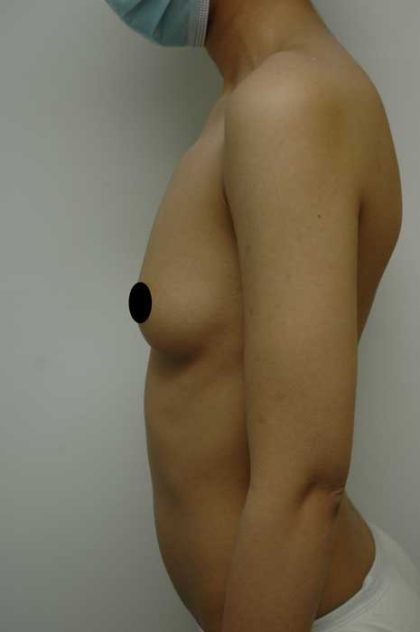 Breast Augmentation Before & After Patient #999