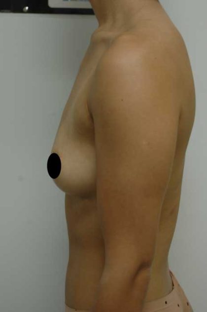 Breast Augmentation Before & After Patient #998