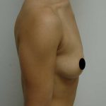 Breast Augmentation Before & After Patient #998