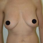 Breast Augmentation Before & After Patient #997