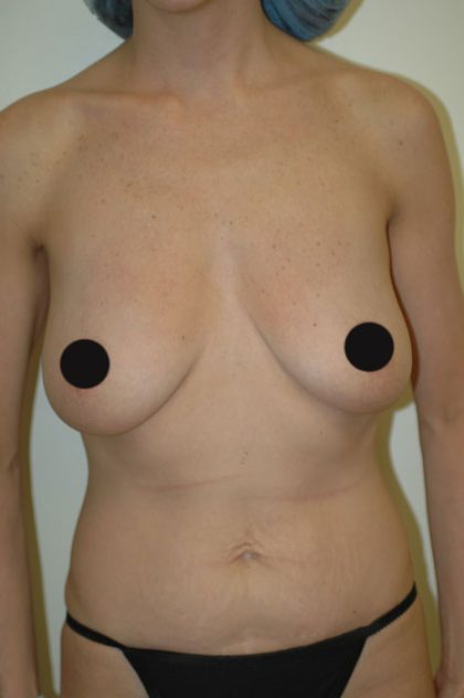 Breast Augmentation Before & After Patient #997