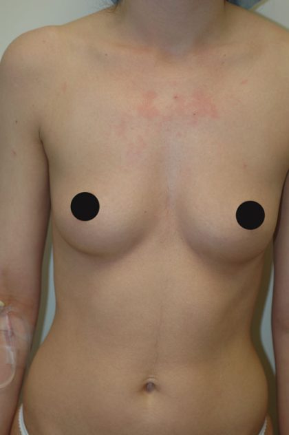 Breast Augmentation Before & After Patient #996