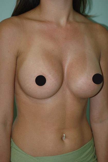 Breast Augmentation Before & After Patient #996