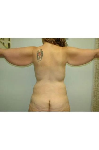 Arm Lift Before & After Patient #1517