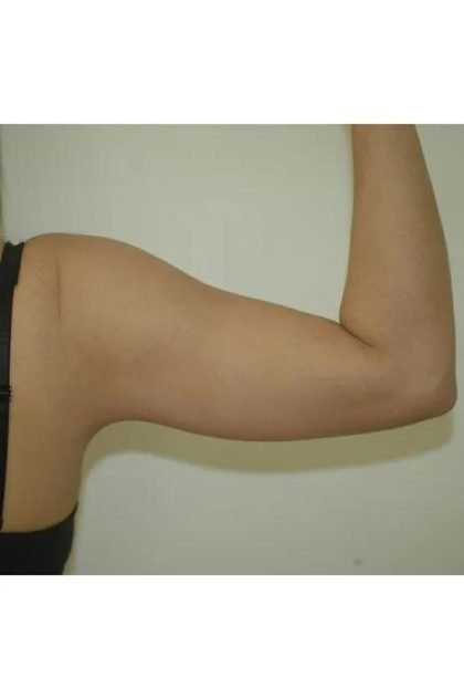 Arm Lift Before & After Patient #1516
