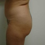 Brazilian Butt Lift Before & After Patient #1617