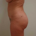 Brazilian Butt Lift Before & After Patient #1617