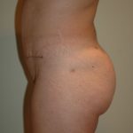 Brazilian Butt Lift Before & After Patient #1607
