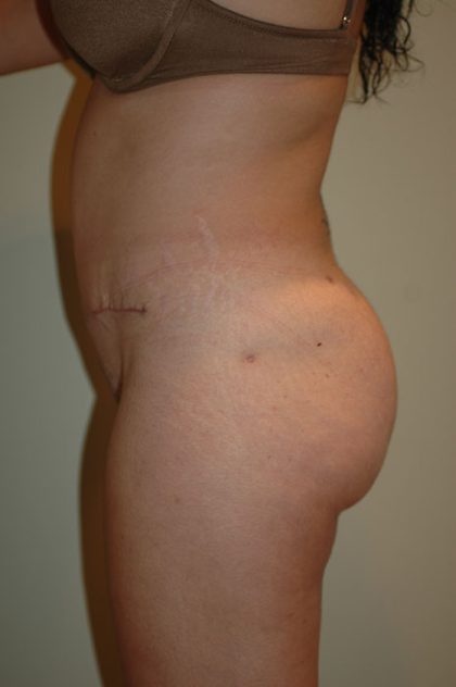 Brazilian Butt Lift Before & After Patient #1607
