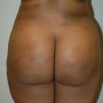 Brazilian Butt Lift Before & After Patient #1606