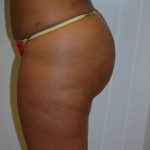 Brazilian Butt Lift Before & After Patient #1606