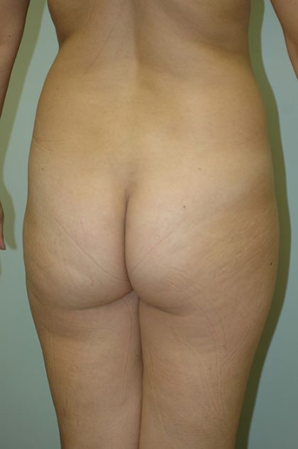 Brazilian Butt Lift Before & After Patient #1605