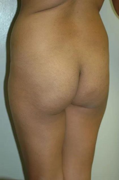 Brazilian Butt Lift Before & After Patient #1604