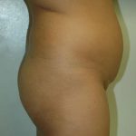 Brazilian Butt Lift Before & After Patient #1604