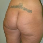 Brazilian Butt Lift Before & After Patient #1603
