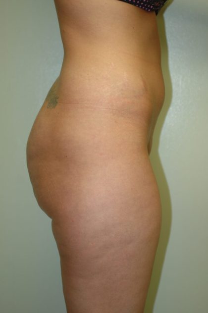 Brazilian Butt Lift Before & After Patient #1603