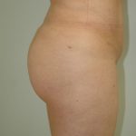 Brazilian Butt Lift Before & After Patient #1602