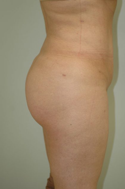 Brazilian Butt Lift Before & After Patient #1602
