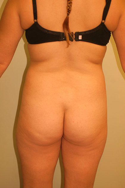 Brazilian Butt Lift Before & After Patient #1601