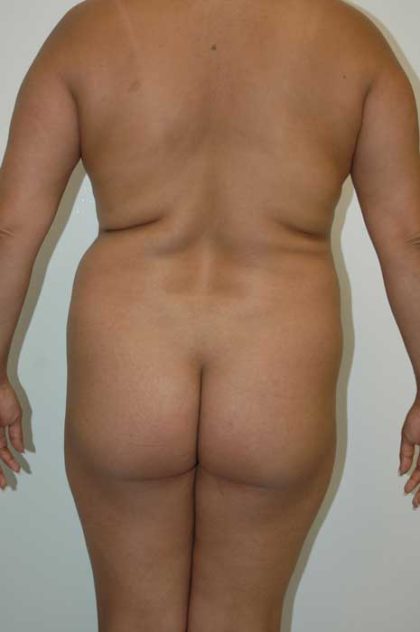 Brazilian Butt Lift Before & After Patient #1615