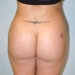 Brazilian Butt Lift Before & After Patient #1614