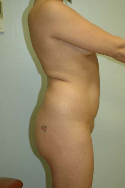 Brazilian Butt Lift Before & After Patient #1614