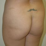 Brazilian Butt Lift Before & After Patient #1613