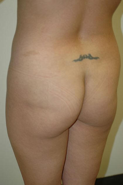 Brazilian Butt Lift Before & After Patient #1613