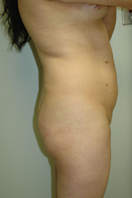 Brazilian Butt Lift Before & After Patient #1610
