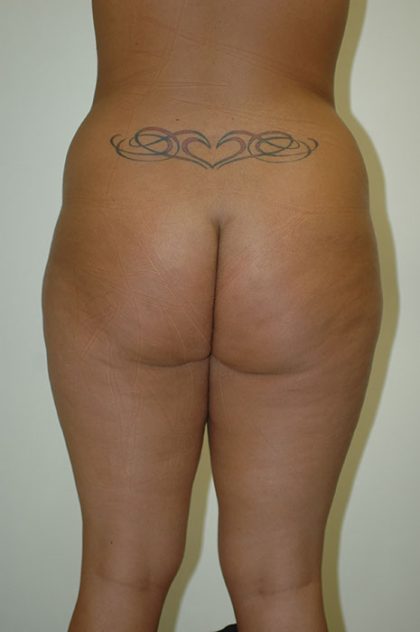 Brazilian Butt Lift Before & After Patient #1609