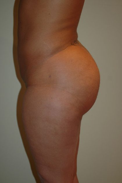 Brazilian Butt Lift Before & After Patient #1609