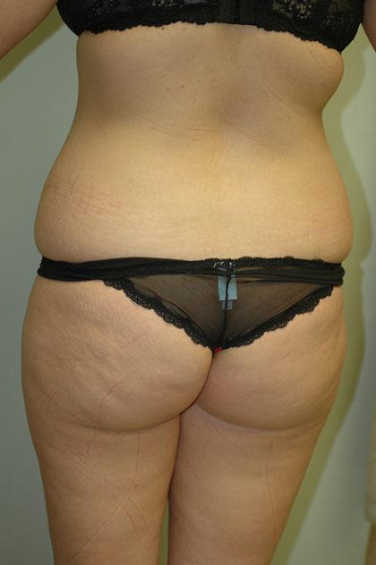 Brazilian Butt Lift Before & After Patient #1608