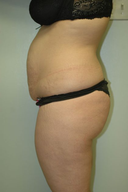 Brazilian Butt Lift Before & After Patient #1608