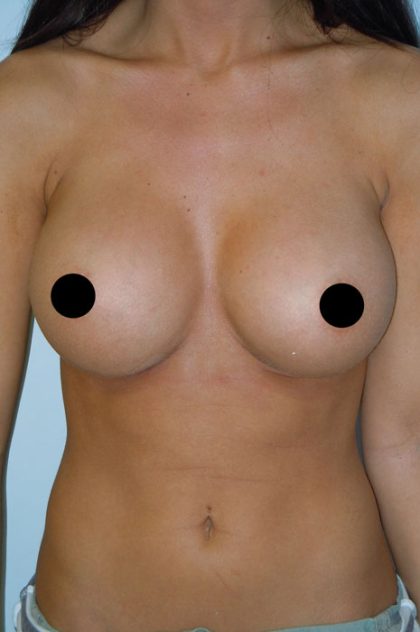 Breast Augmentation & Lift Before & After Patient #1414