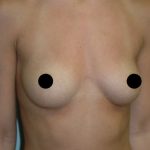 Breast Augmentation & Lift Before & After Patient #1414