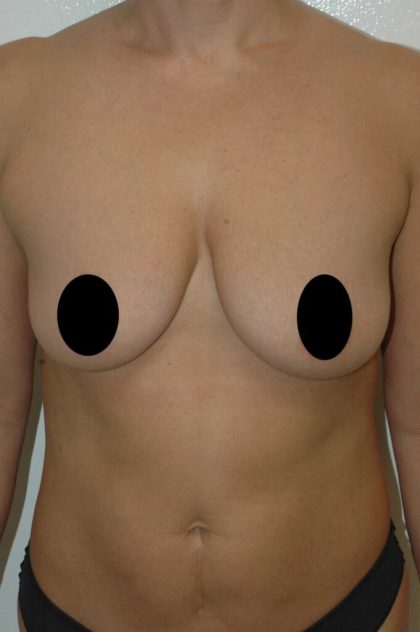 Breast Augmentation & Lift Before & After Patient #1406
